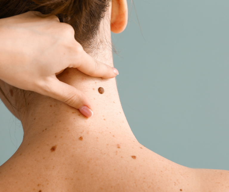 What Different Moles On Your Body Say About You